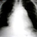 Tomografia do tórax com um tumor no mediastino (visível em branco, no meio da imagem) e invasão do tumor na região anterior das costelas.