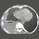 Tomografia do tórax com derrame pleural (vermelho) com dreno em seu interior (branco).