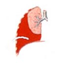 Derrame pleural drenado (drenagem do tórax).