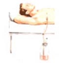 Empiema drenado (drenagem do tórax).