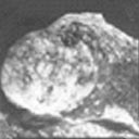 Tumores de mediastino, após terem sido retirados por intermédio de uma cirurgia.