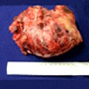 Tumores de mediastino, após terem sido retirados por intermédio de uma cirurgia.