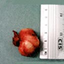 Tumores de mediastino, após terem sido retirados por intermédio de uma cirurgia.