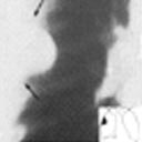 Tumor (localizado) da pleura do lado esquerdo, em branco.