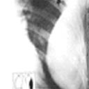 Tumor (localizado) da pleura do lado direito, em branco.